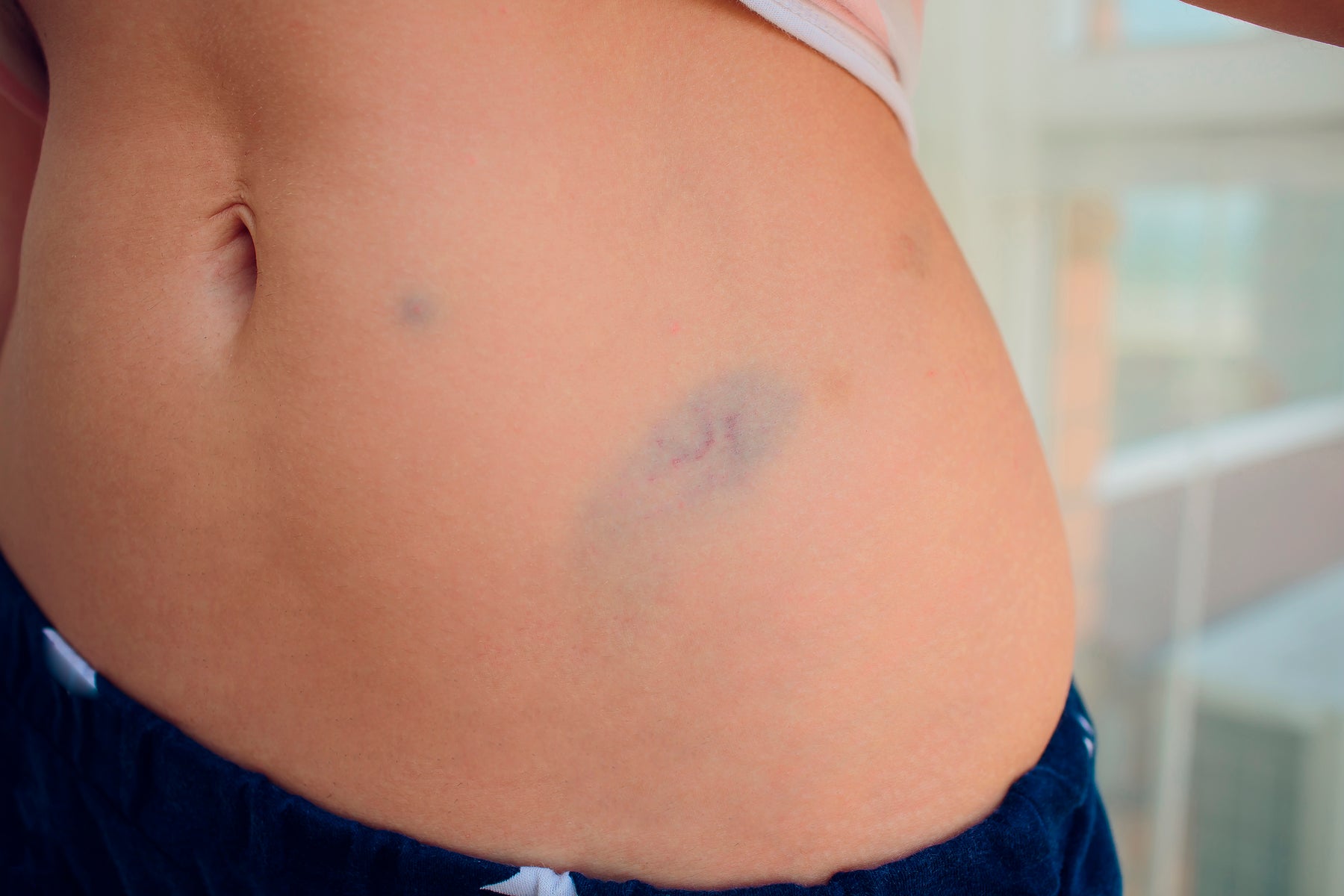 HGH bruise on skin stomach after Human Growth Hormone injections