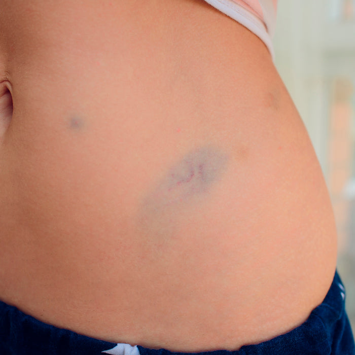 HGH bruise on skin stomach after Human Growth Hormone injections